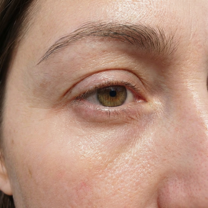 Hyaluronic microneedle eye patches - Shanaz Riasoth 