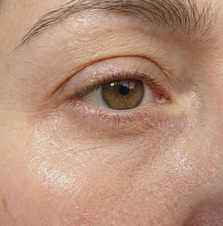 Hyaluronic microneedle eye patches - Shanaz Riasoth 